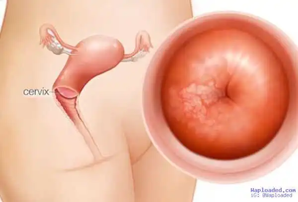 9,000 Women Die Of Cervical Cancer Yearly In Nigeria, Says Oncologist
